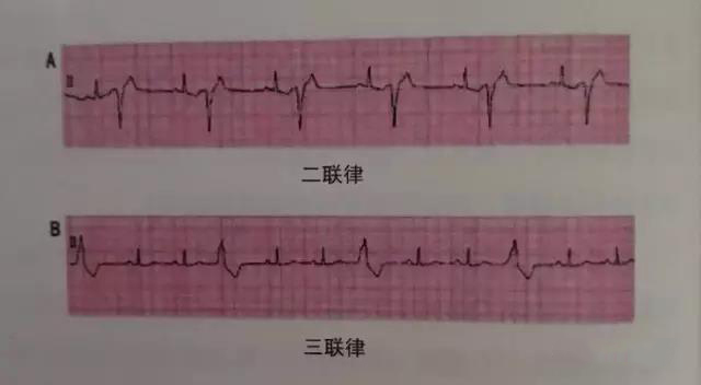 【转载】胡大一: 认识早搏和心房颤动